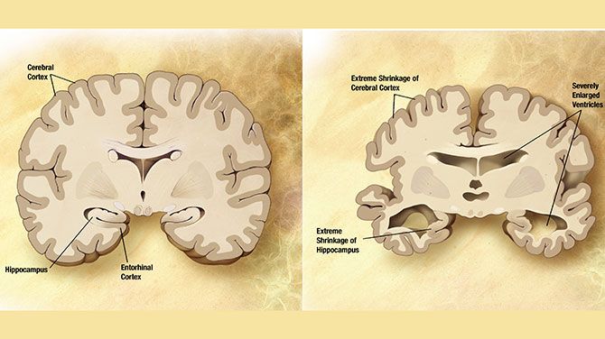 Vergelijking, hersenen, Alzheimer